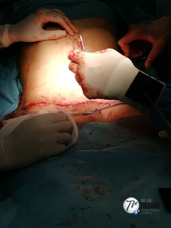 abdominoplastia, acabando la cirugia